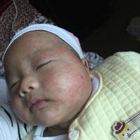 新生儿为什么长湿疹,新生儿为什么的湿疹？